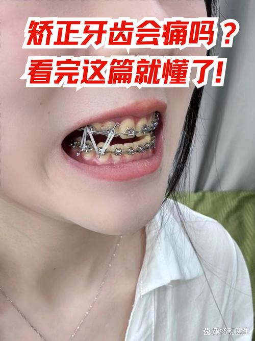 矫正牙齿后牙齿酸痛正常吗?原因是什么,怎么缓解?-图1 矫正牙齿后牙齿酸痛正常吗?原因是什么,怎么缓解?-图1