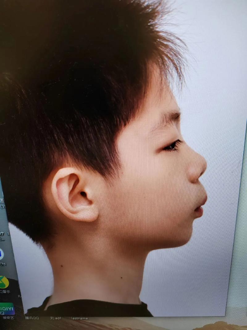 矫正牙齿后牙齿酸痛正常吗?原因是什么,怎么缓解?-图3 矫正牙齿后牙齿酸痛正常吗?原因是什么,怎么缓解?-图3