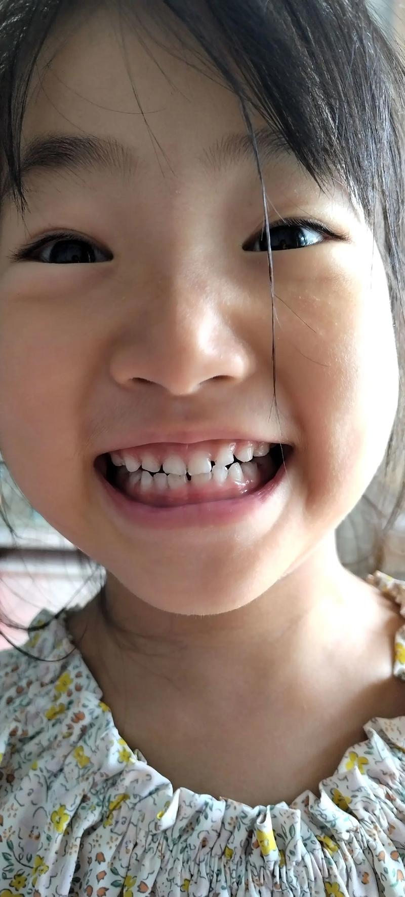 矫正一个月牙齿效果如何？变化是否正常？-图1