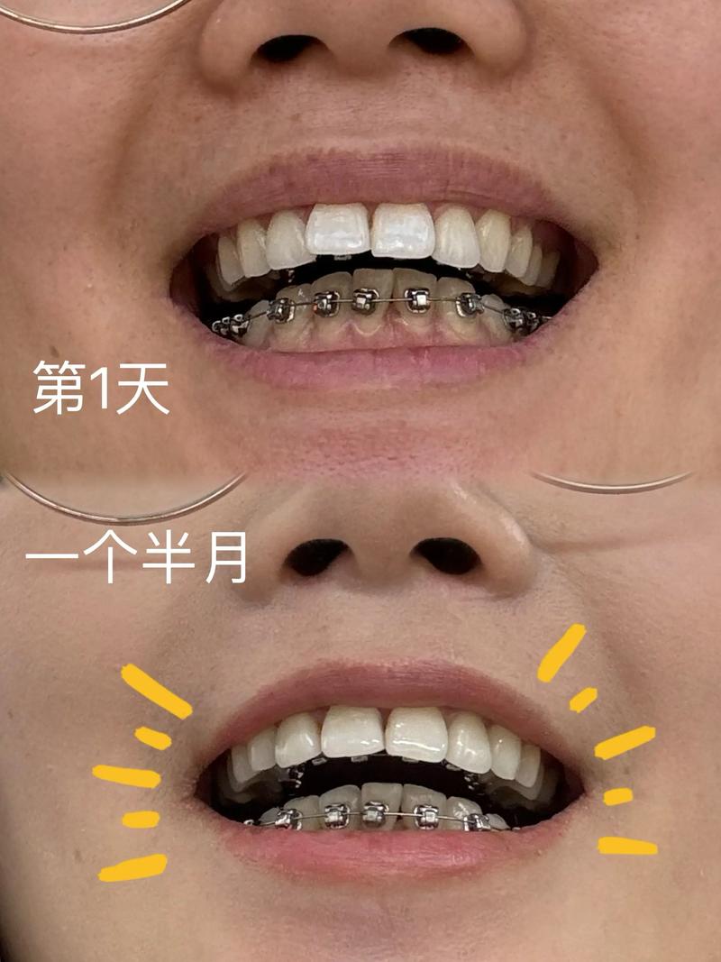 矫正牙齿只整上排？效果和美观能兼顾吗？-图2
