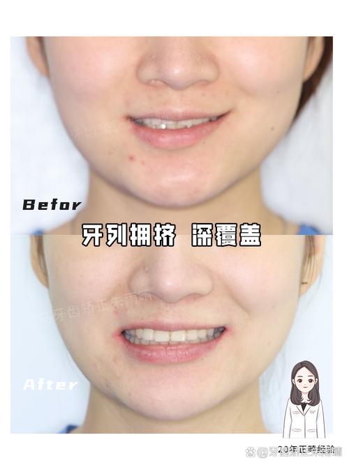 矫正牙齿只整上排？效果和美观能兼顾吗？-图3