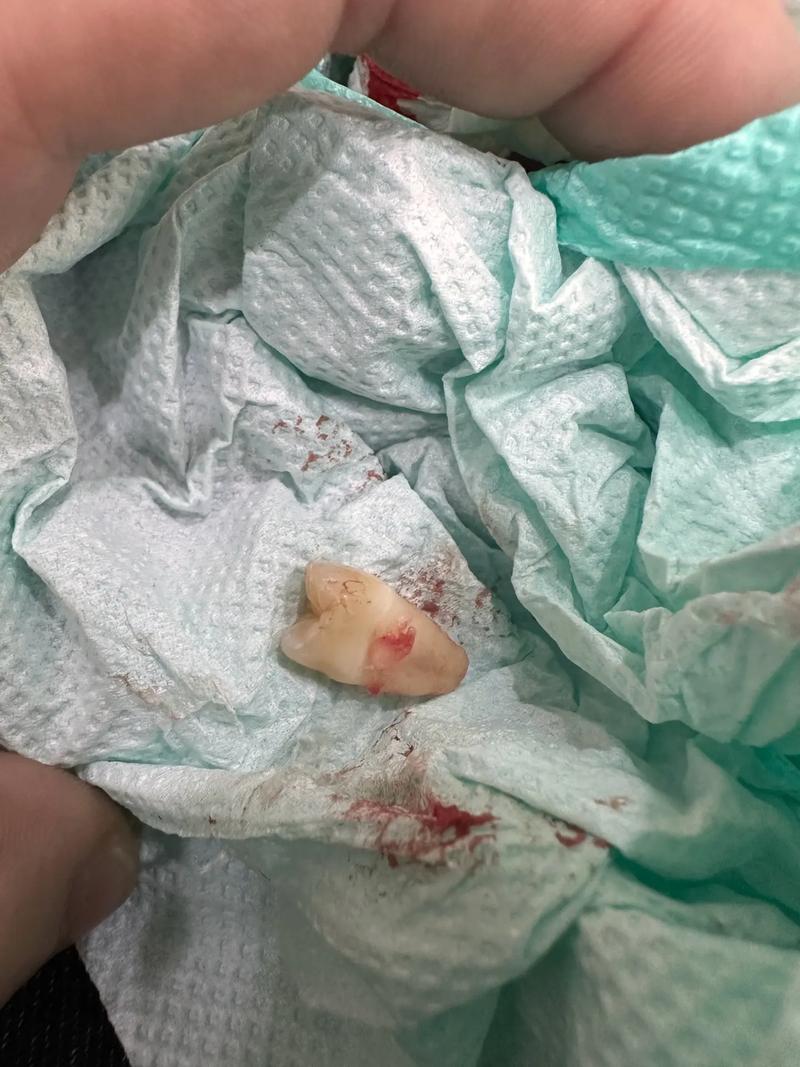 牙齿矫正下牙拔一颗-图1