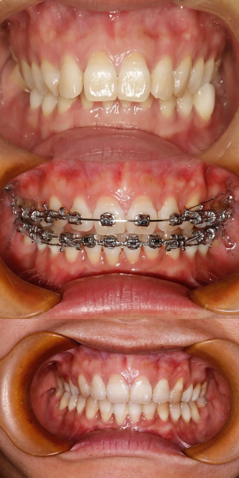 矫正牙齿带牙环的图,牙环有何作用?-图3 矫正牙齿带牙环的图,牙环有何作用?-图3