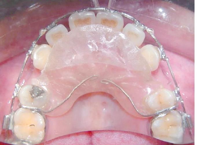 儿童活动牙齿矫正器，适用年龄、效果及注意事项有哪些？-图2