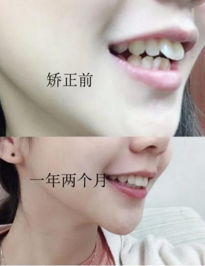 矫正牙齿有变丑的吗-图1 矫正牙齿有变丑的吗-图1