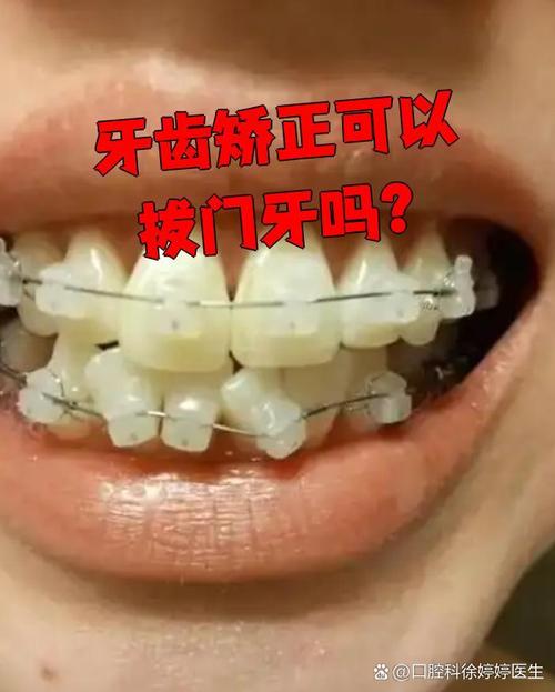 牙齿矫正为何要拔8颗牙?必要还是过度?-图2 牙齿矫正为何要拔8颗牙?必要还是过度?-图2