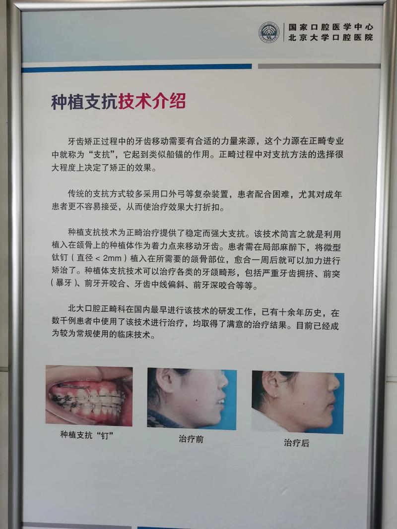 北大校医院矫正牙齿-图1 北大校医院矫正牙齿-图1