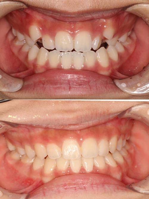 北大校医院矫正牙齿-图3 北大校医院矫正牙齿-图3