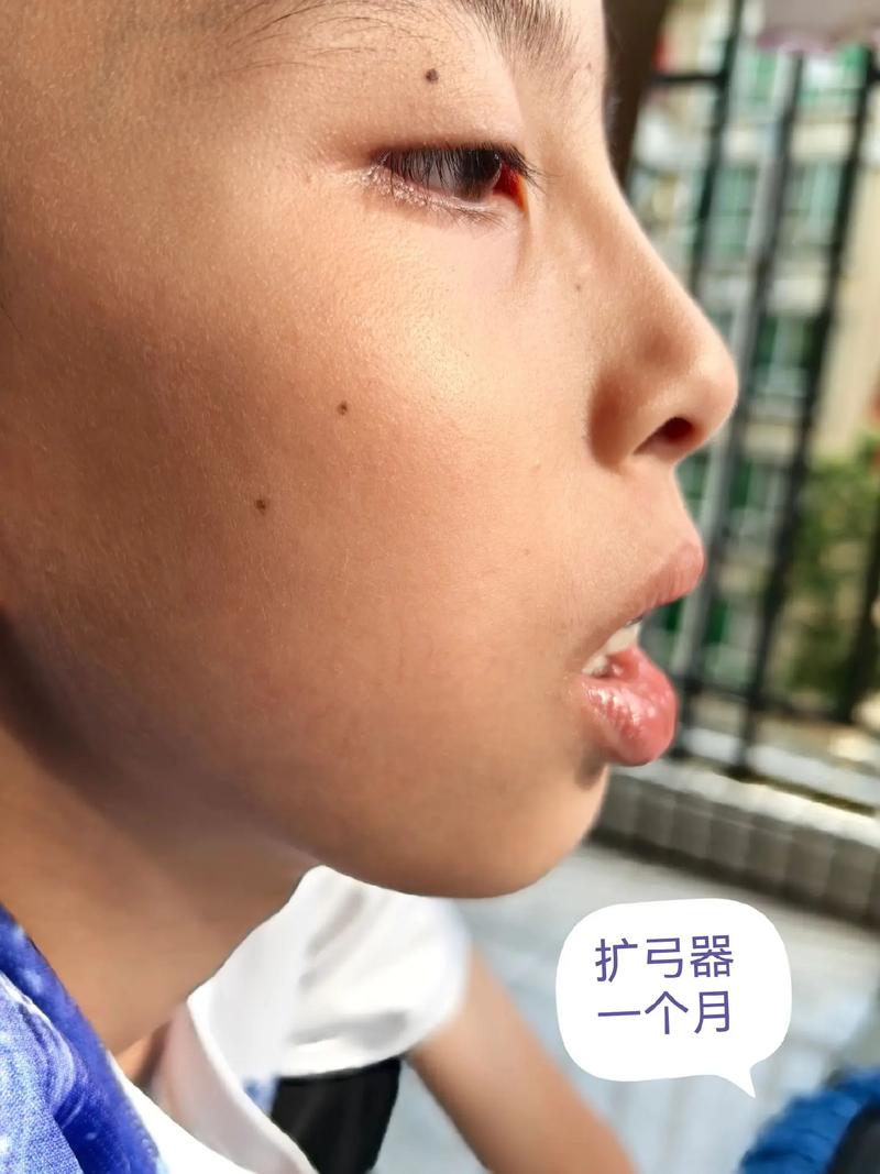 八岁矫正牙齿,这个年龄开始矫正到底合不合适?-图3 八岁矫正牙齿,这个年龄开始矫正到底合不合适?-图3