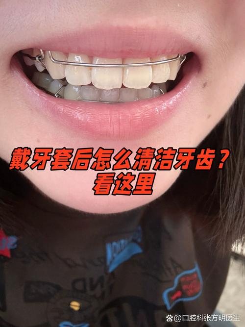牙齿矫正戴牙套会痛吗？-图2