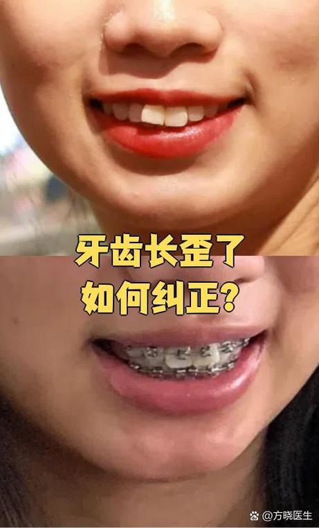 牙齿矫正大牙拉歪了？该怎么办？-图3