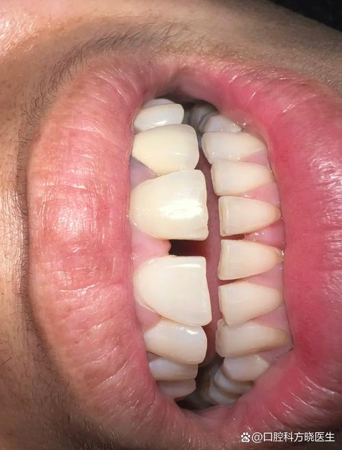 牙齿矫正后牙缝变大？原因何在？-图1