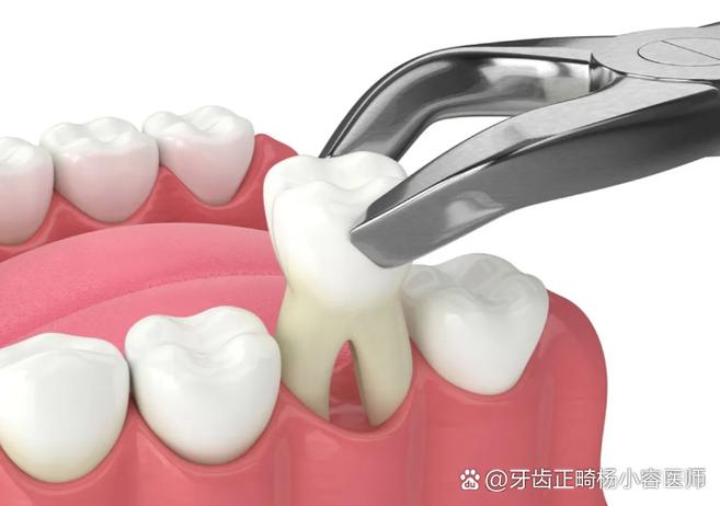 牙齿矫正拔牙，到底该拔哪颗牙齿？-图2