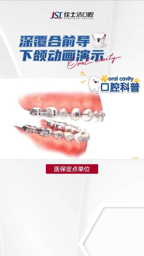 牙齿矫正前导的作用具体有哪些？-图3