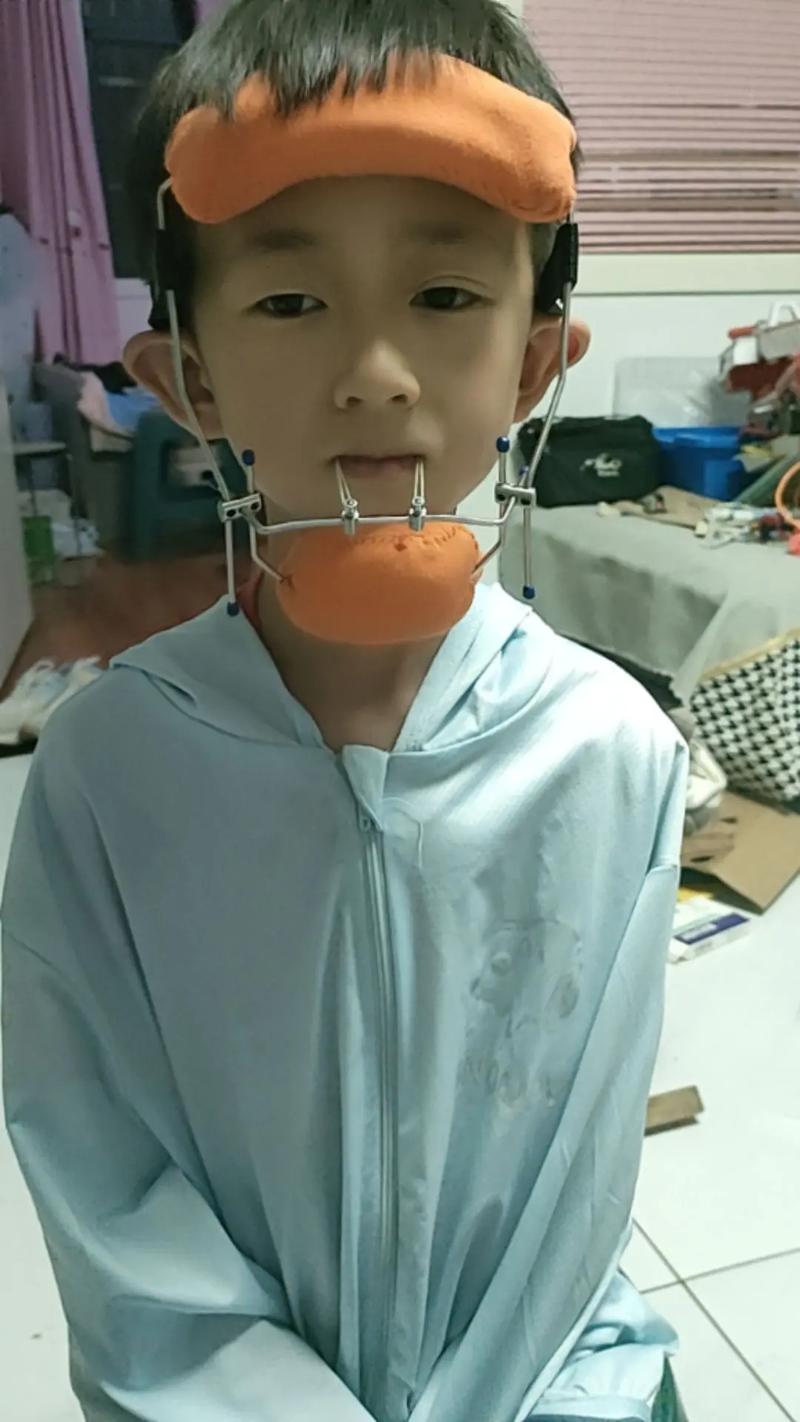 牙齿地包天矫正疼吗？治疗过程会有多痛苦？-图2