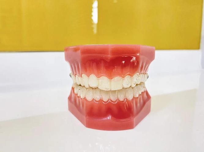 进口牙齿矫正器价格为何差异这么大？-图3