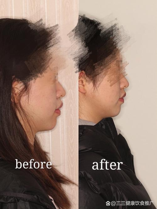 牙齿矫正后为何还嘴凸？矫正方案哪里出了问题？-图1