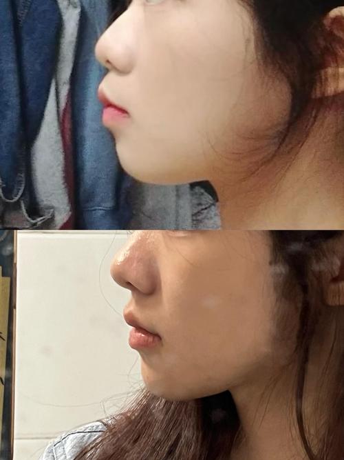 牙齿矫正后为何还嘴凸？矫正方案哪里出了问题？-图3