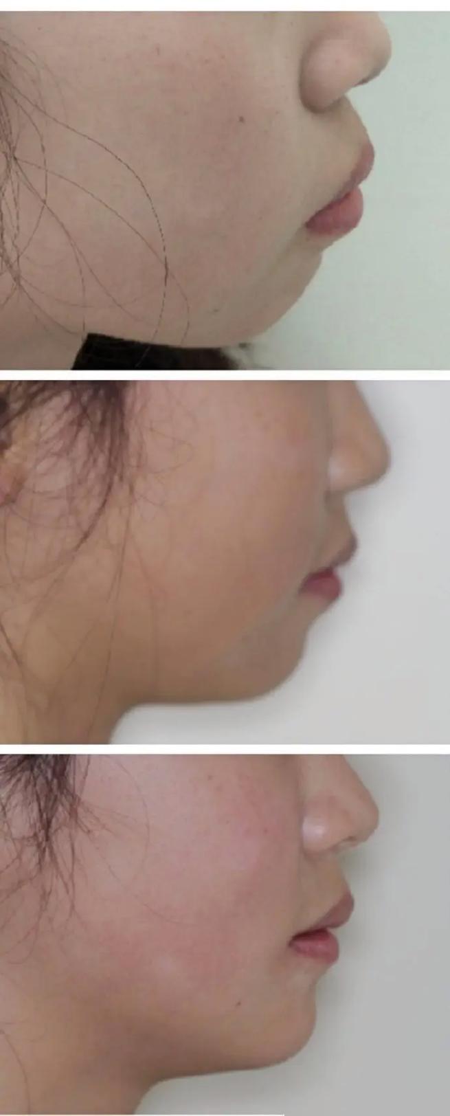 牙齿矫正后，牙齿会松动吗？-图1