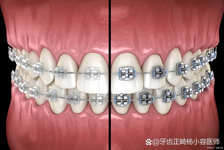 牙齿矫正后，牙齿会松动吗？-图3