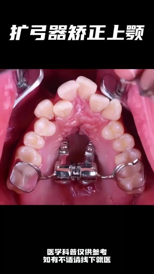 牙齿矫正扩弓的过程，那种难受感真的像传说中那么难以忍受吗？-图1
