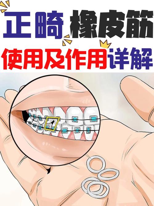 牙齿矫正牵引橡皮圈的作用和效果究竟如何?-图1 牙齿矫正牵引橡皮圈的作用和效果究竟如何?-图1