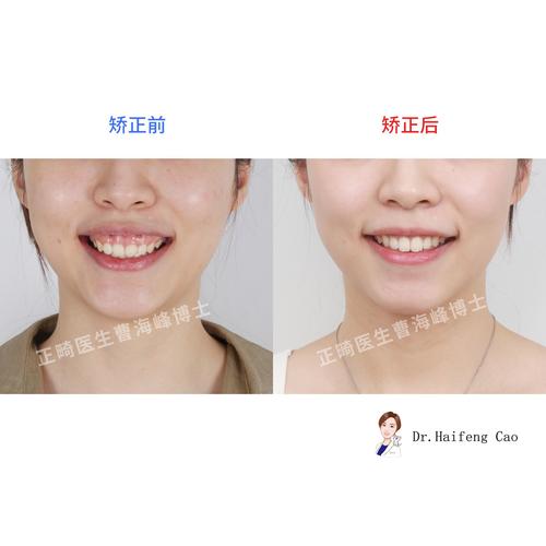 24岁矫正牙齿还来得及吗？成年人矫正会不会太晚？-图1