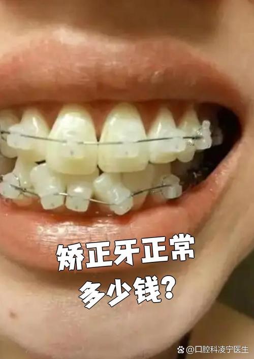 牙齿矫正中途能换医院吗？-图3