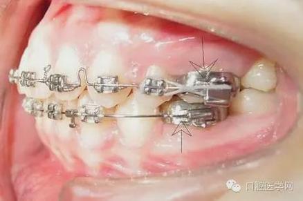 牙齿矫正全过程图片有哪些关键步骤?-图3 牙齿矫正全过程图片有哪些关键步骤?-图3