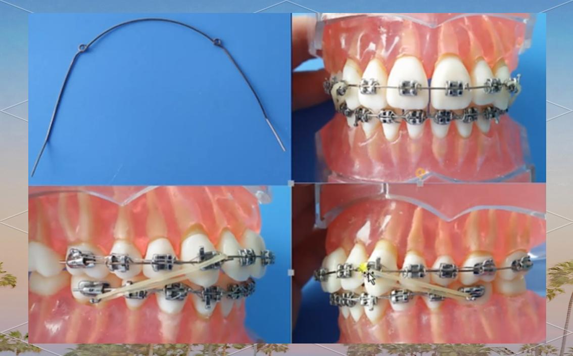 牙齿矫正最先进技术是什么？效果与传统方式相比如何？-图2