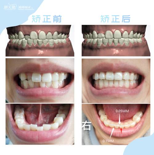 大龄矫正牙齿，后遗症真会找上门？这些风险你必须知道！-图2