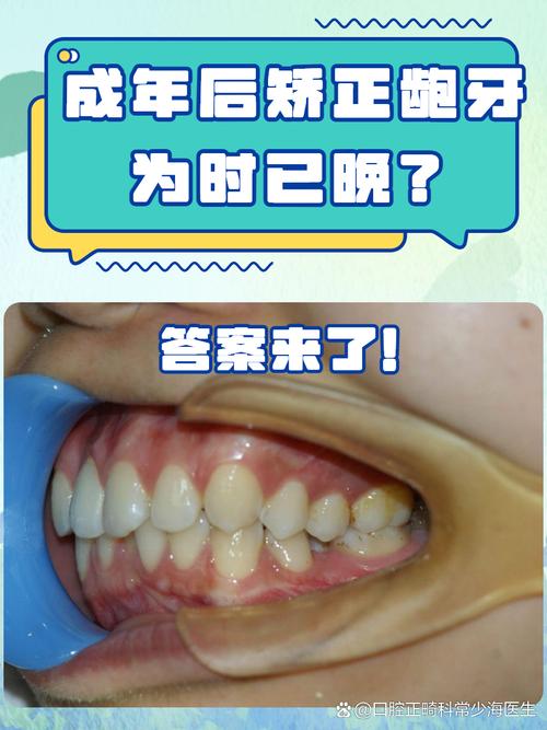 牙齿矫正反弹几率真的很大吗?-图3 牙齿矫正反弹几率真的很大吗?-图3