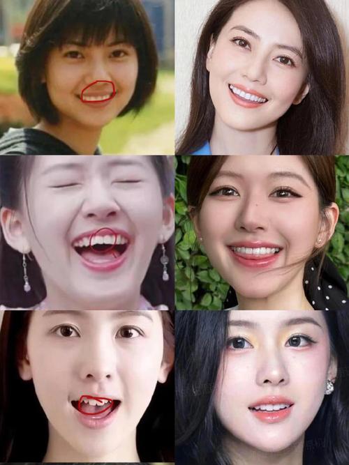 明星牙齿矫正对比图-图1