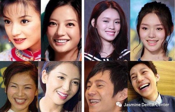 明星牙齿矫正对比图-图3