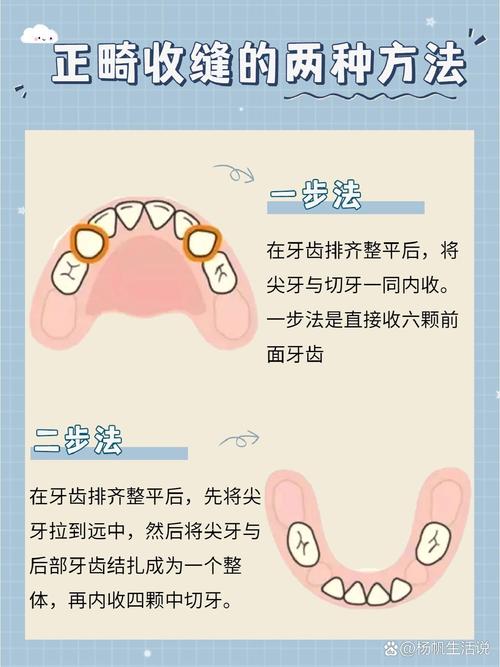 牙齿矫正如何有效收牙缝？这些方法帮你搞定-图1