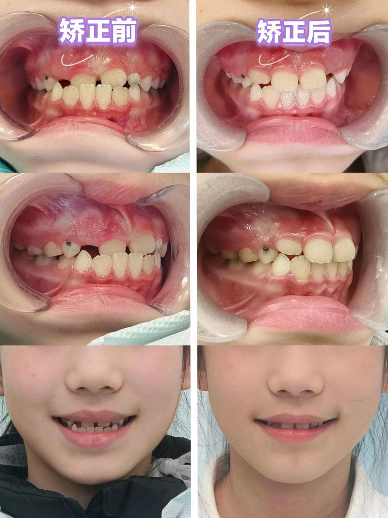矫正牙齿后门牙前突-图2