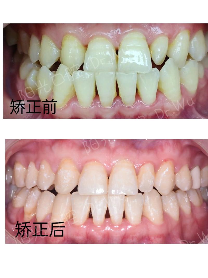 北京顺义区牙齿矫正,如何选择靠谱机构与效果保障?-图2 北京顺义区牙齿矫正,如何选择靠谱机构与效果保障?-图2