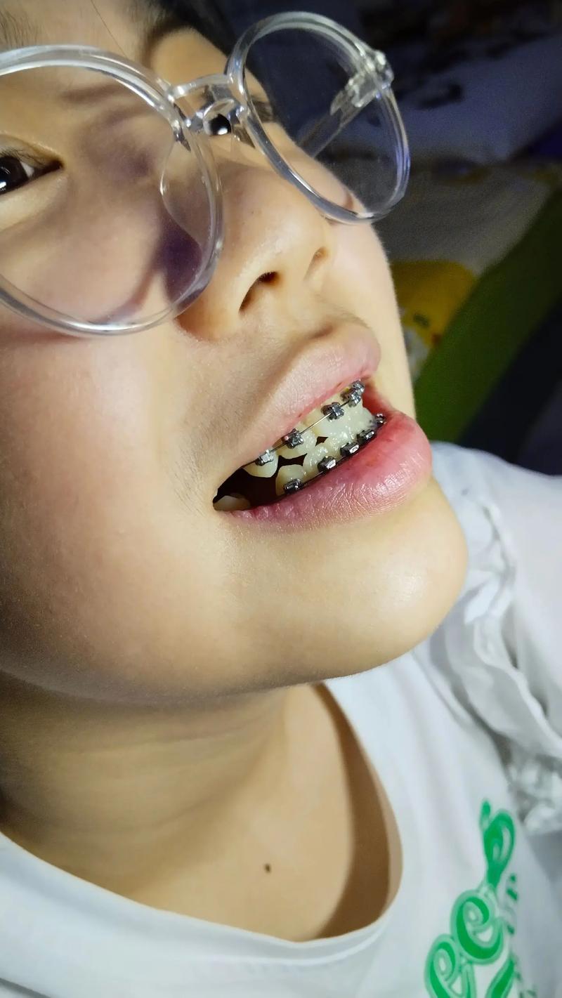 深圳宝安牙齿矫正，哪种方案更适合自己？-图2