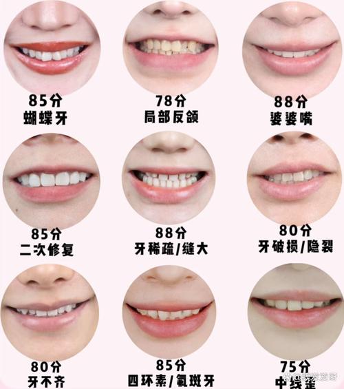 龅牙牙齿矫正要多久-图1 龅牙牙齿矫正要多久-图1