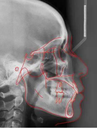 牙齿矫正头颅侧位片有何关键作用？-图1
