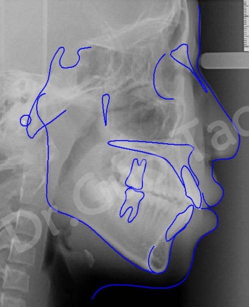 牙齿矫正头颅侧位片有何关键作用？-图2