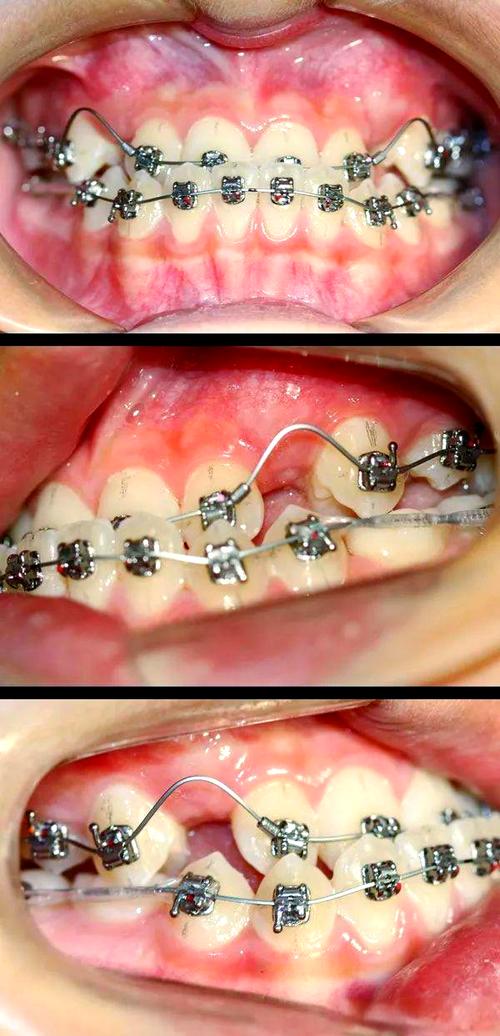 地包天牙齿矫正视频-图2