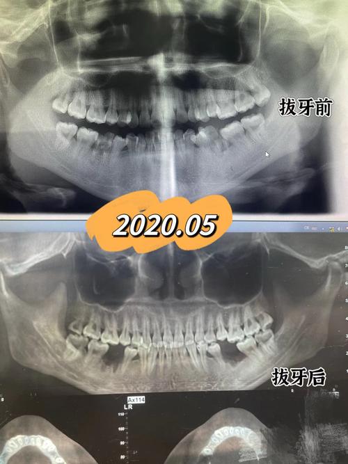 20岁矫正牙齿晚吗？成年后矫正还来得及吗？-图3