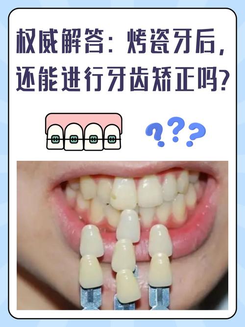 补过的牙齿能矫正吗-图1 补过的牙齿能矫正吗-图1
