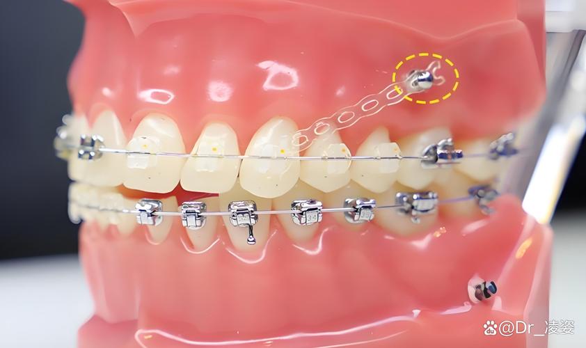 牙齿矫正打骨钉图片能看清哪些关键矫正细节？-图1
