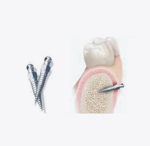 牙齿矫正打骨钉图片能看清哪些关键矫正细节？-图2