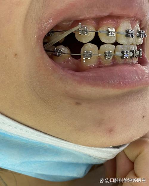 22岁矫正牙齿晚吗？现在矫正还来得及吗？-图1