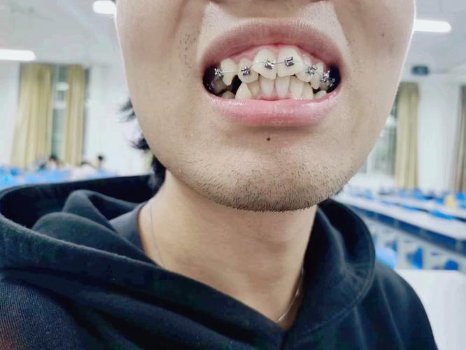 牙齿矫正半年后效果如何？变化明显吗？效果图能体现真实效果吗？-图1