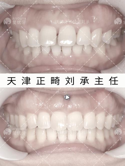 天津牙齿矫正哪家好?如何找到靠谱的矫正机构?-图2 天津牙齿矫正哪家好?如何找到靠谱的矫正机构?-图2