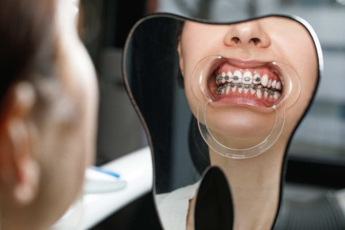 自己用舌头矫正牙齿-图2